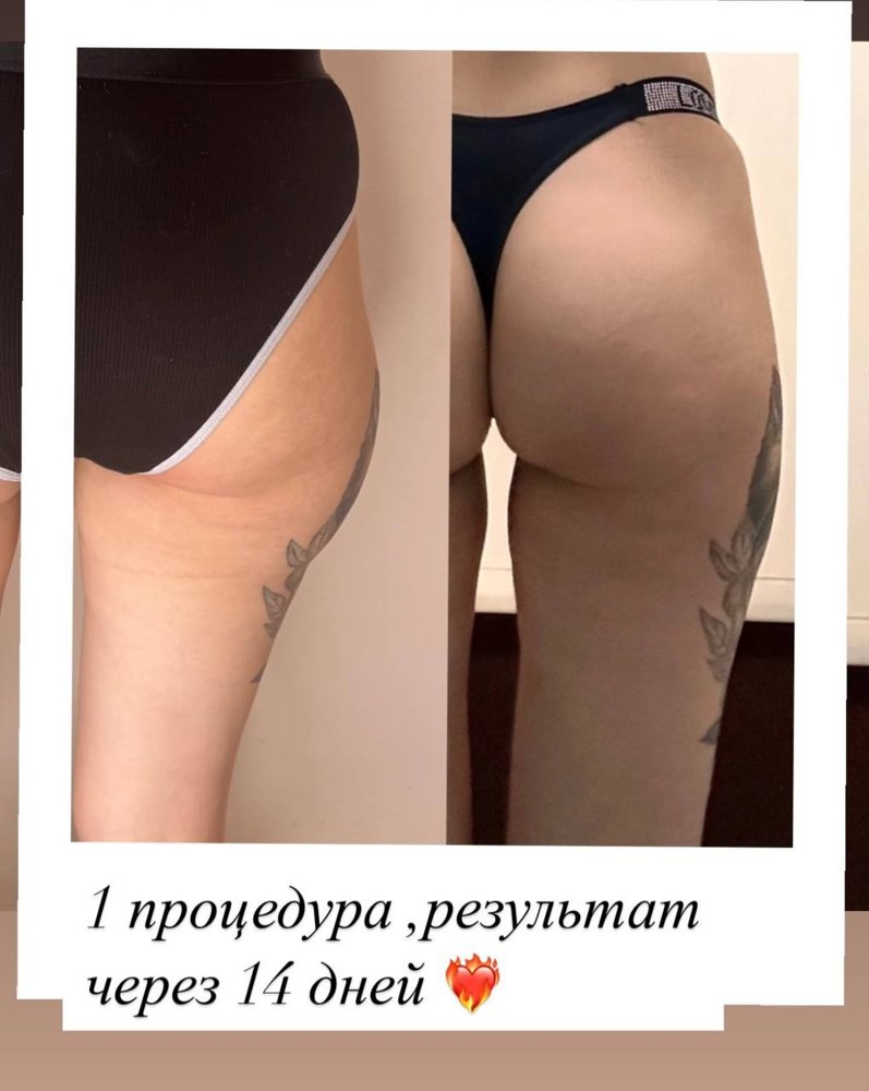 До и после процедуры липолитика, зона ягодиц и бёдер